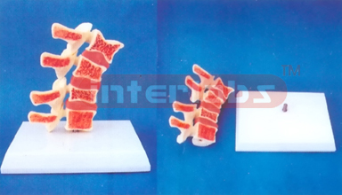 BIG HALF VERTEBREA COMPARISON AND DEMONSTRATION MODEL FOR HEALTH, DISEASES AND OSTEOPOROSIS